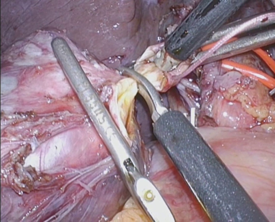図2　腹腔鏡下胆道拡張症　手術の様子