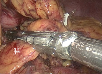 図2　自動縫合器での膵切離（腹腔鏡下）