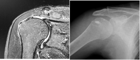 左　術前MRI:棘上筋断裂(+)　右　術後単純X線撮影