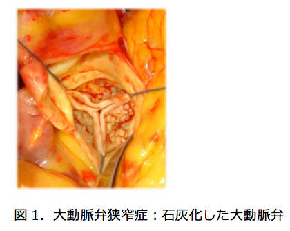 大動脈弁狭窄症：石灰化した大動脈弁