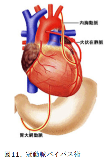 冠動脈バイパス術